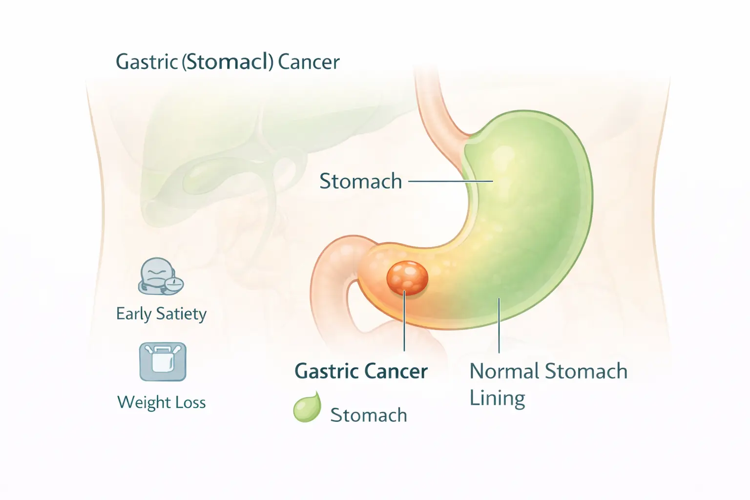 Stomach Cancer Anatomy Diagram