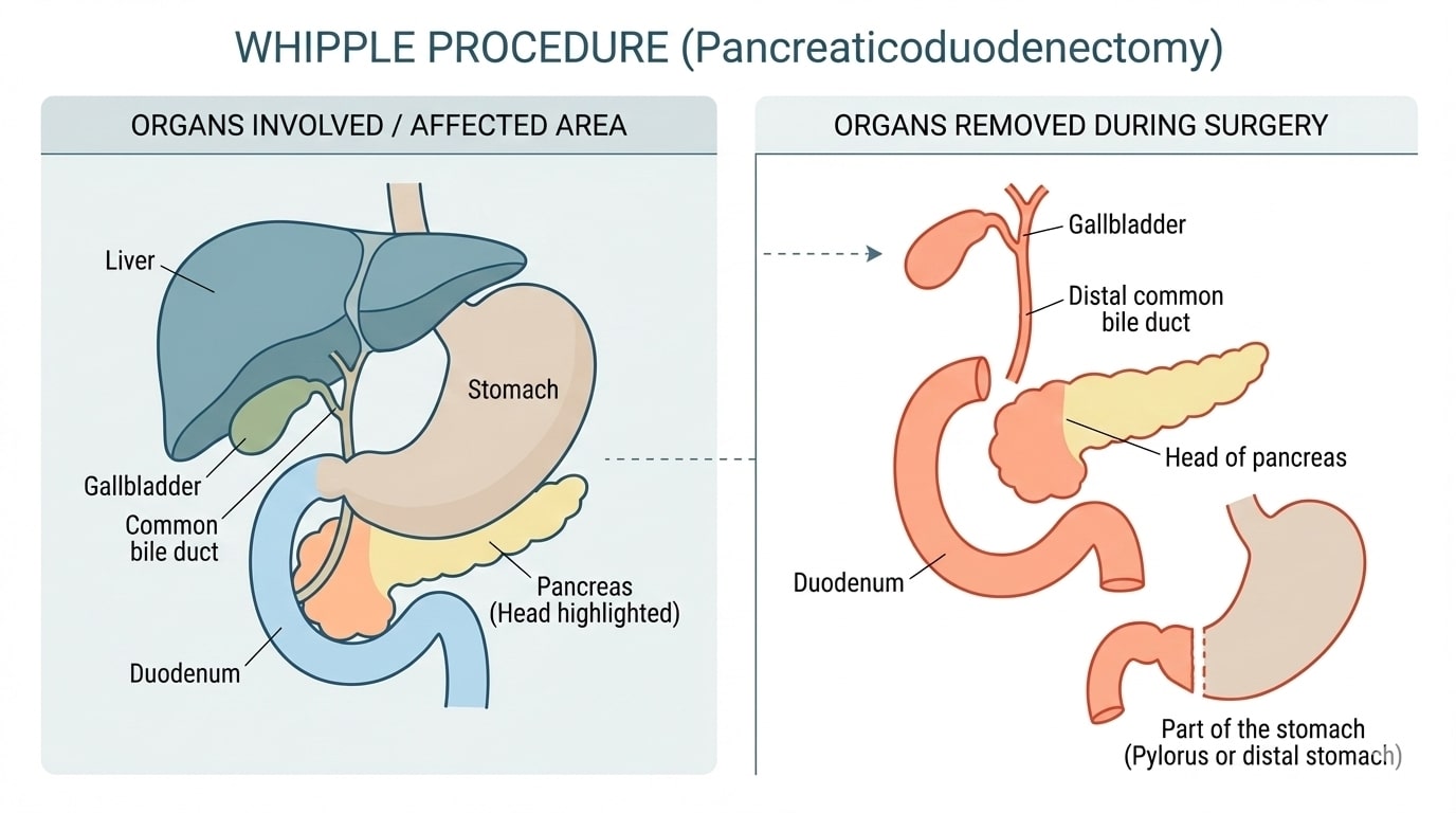 Whipple Procedure Diagram - Pancreaticoduodenectomy Steps showing removal and reconstruction