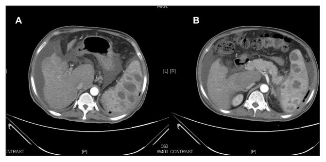 Tumor Treatment in Electronic City