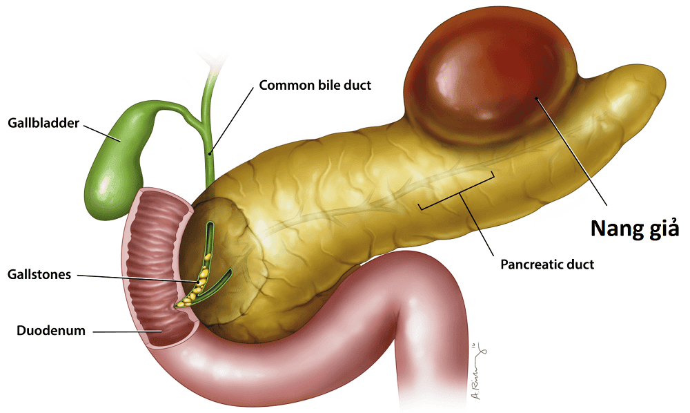 Pancreatic Pseudocyst Treatment in Electronic City