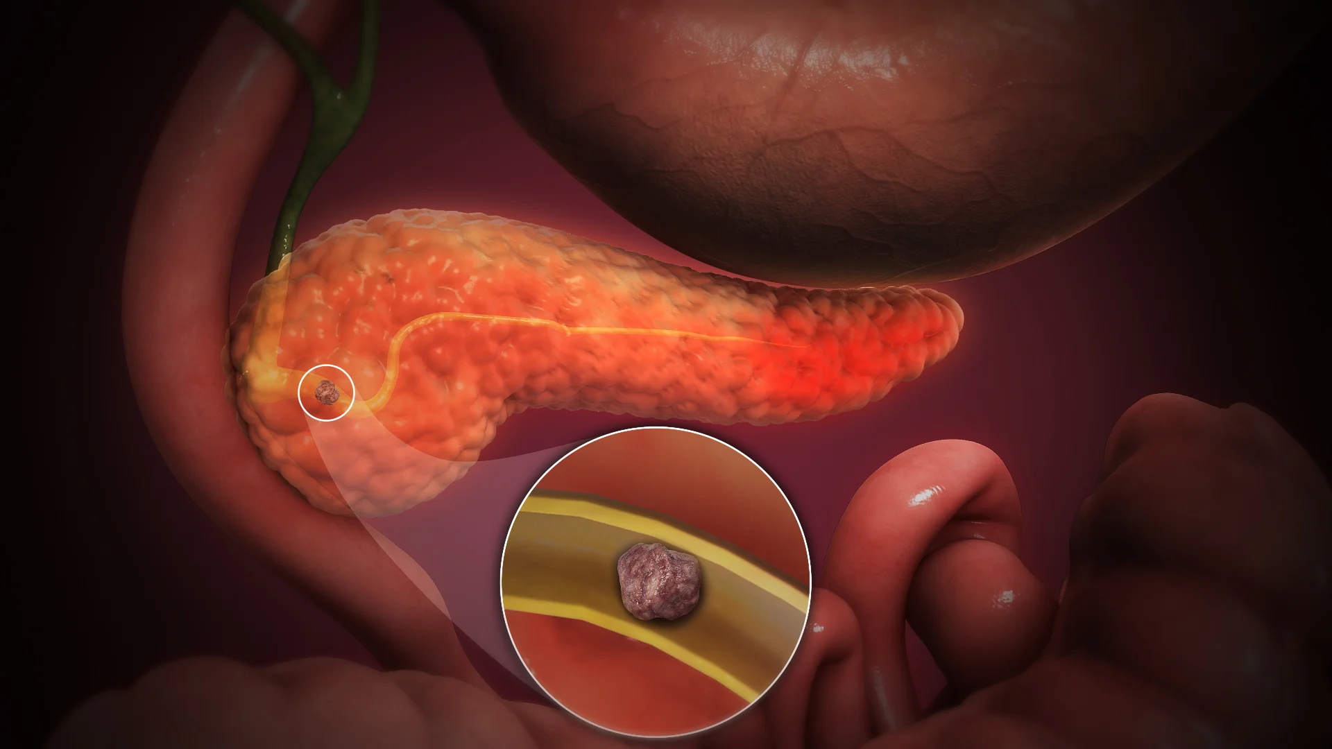 Pancreas Tumor Care in Electronic City