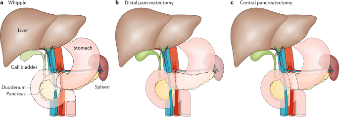 Pancreatic Cystic Neoplasm Care in Electronic City