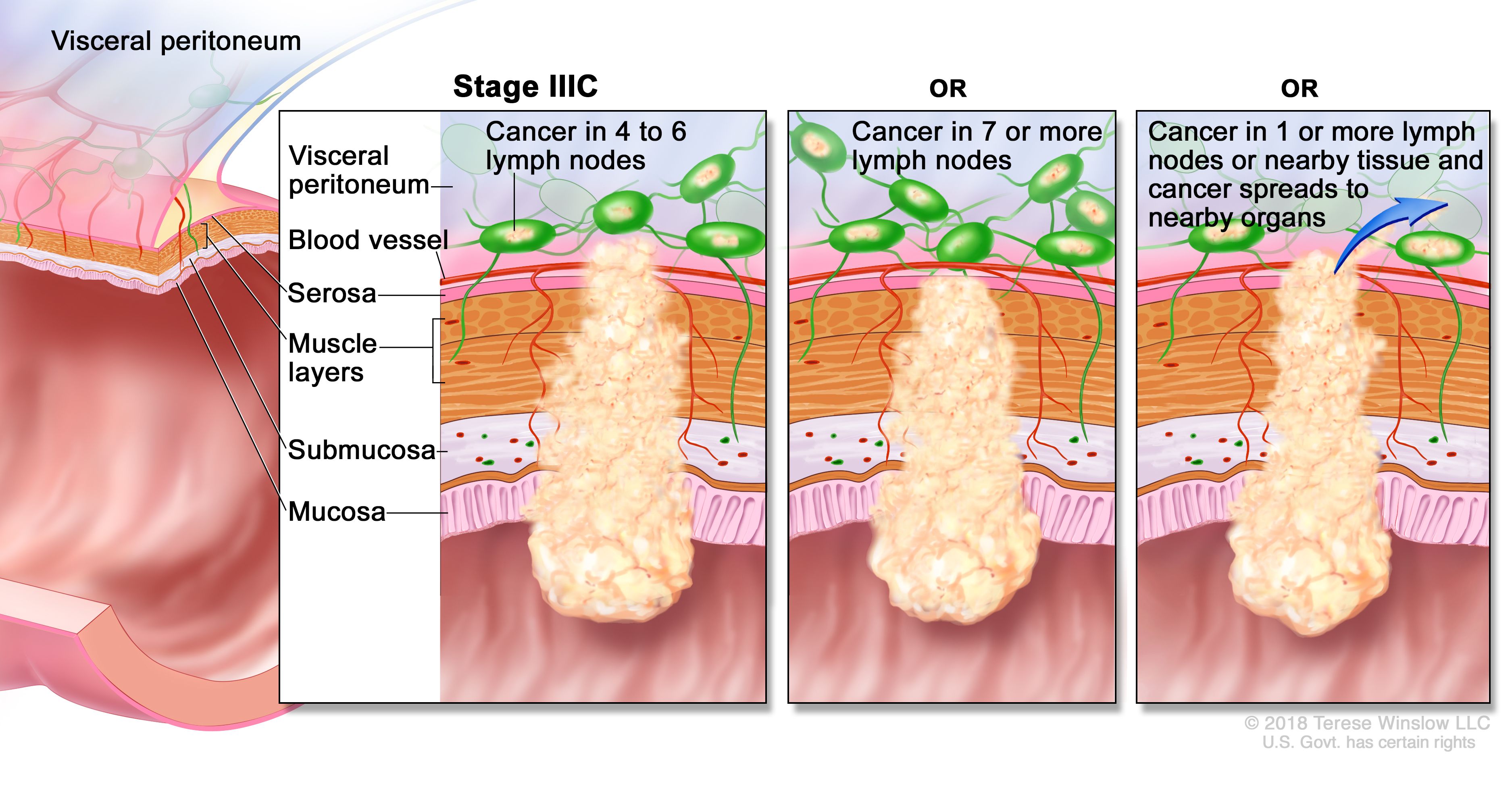 Rectal Cancer Care in Electronic City
