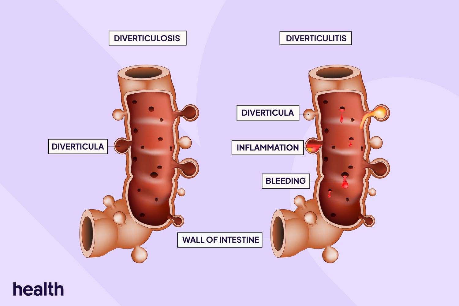 Diverticulosis Treatment in Electronic City