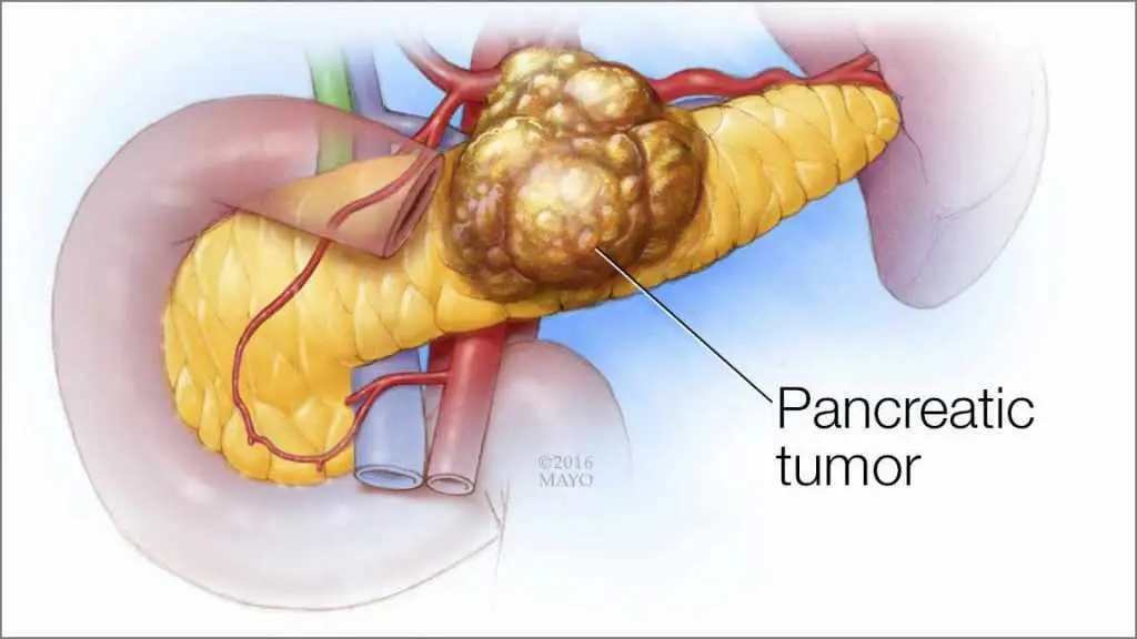 Pancreas Tumor Care in Electronic City