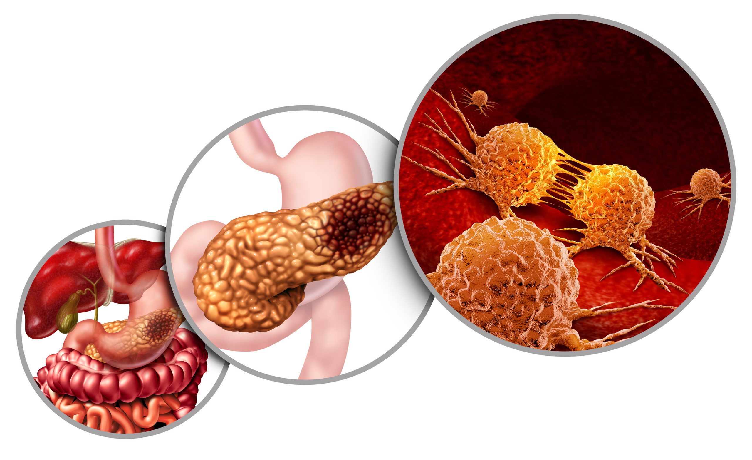 Pancreas Tumor Care in Electronic City
