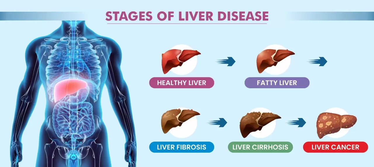 Liver Cirrhosis of Treatment in Electronic City