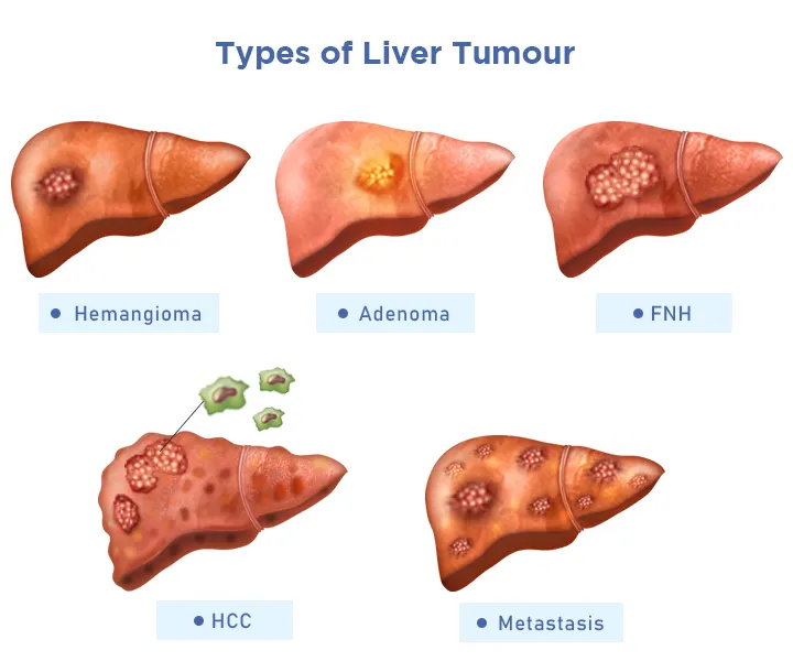 Liver Tumors Treatment in Electronic City