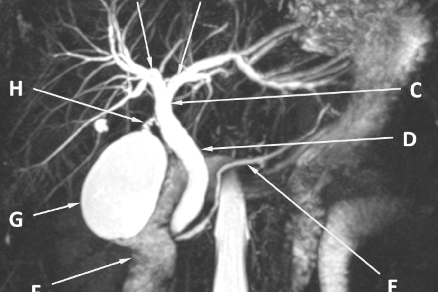 Gall Bladder Treatment in Electronic City