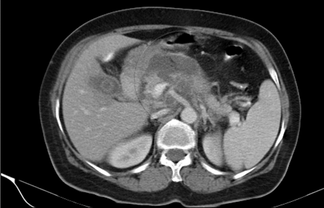 Necrotizing Pancreatitis Treatment in Electronic City