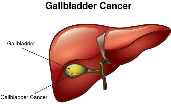 Gall Bladder Cancer Treatment in Electronic City
