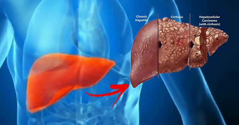 Liver Tumor Treatment in Electronic City