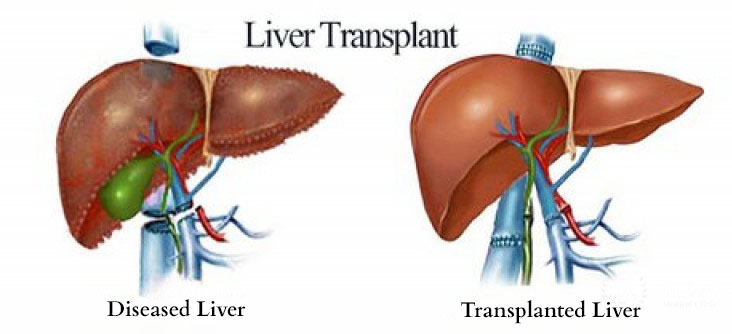 Gall Bladder Treatment in Electronic City