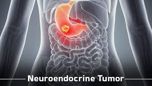 Pancreatic Cancer Specialists in Electronic City