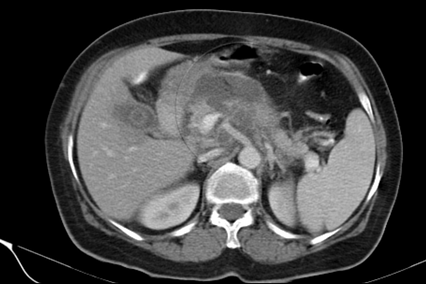 Expert Transplant Surgeon in Electronic CityExpert Transplant Surgeon in Electronic City