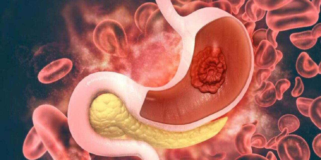 Stomach Cancer Treatment in Electronic City