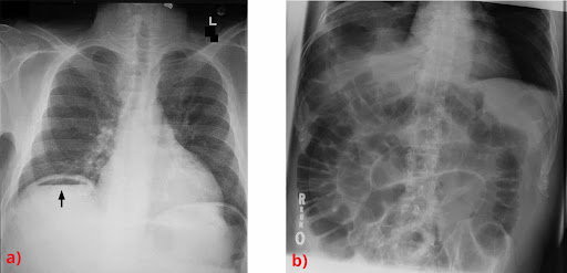 Perforation Treatment in Electronic City
